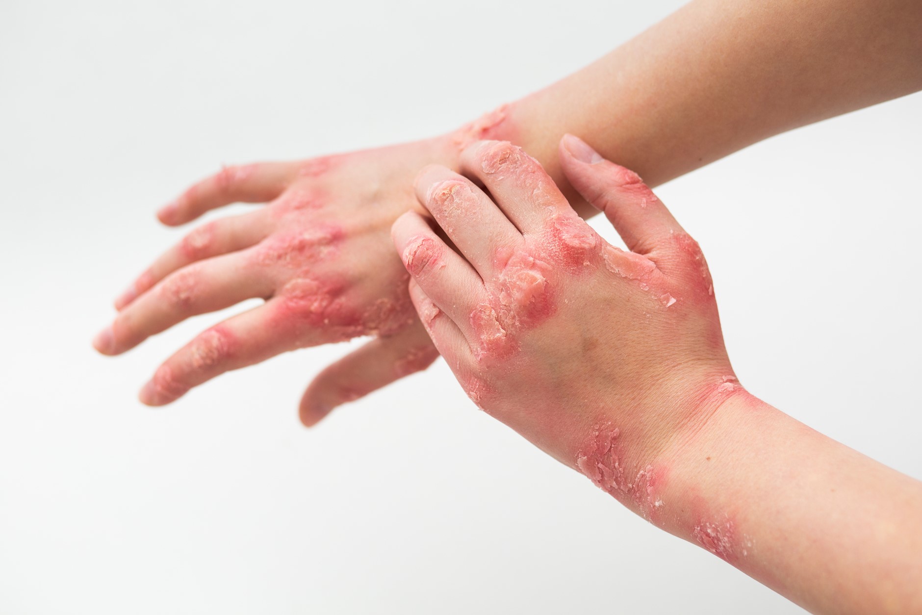 Psoriasis Triggers: What You Need to Know