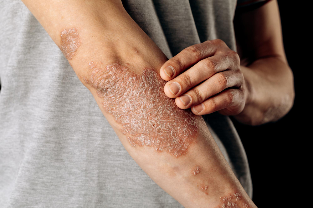 Psoriasis: Causes, Symptoms, Diagnosis, and Treatment