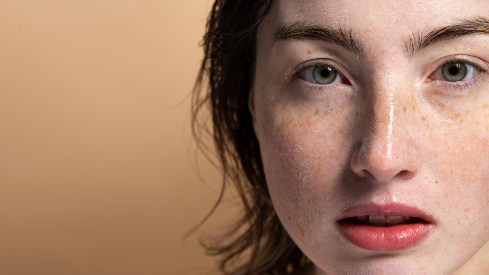 Melasma vs. Freckles: Differences and Best Treatments