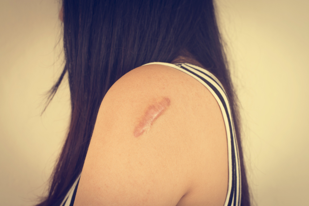 Keloids & Hypertrophic Scars: Causes, Symptoms, Diagnosis, and Treatment