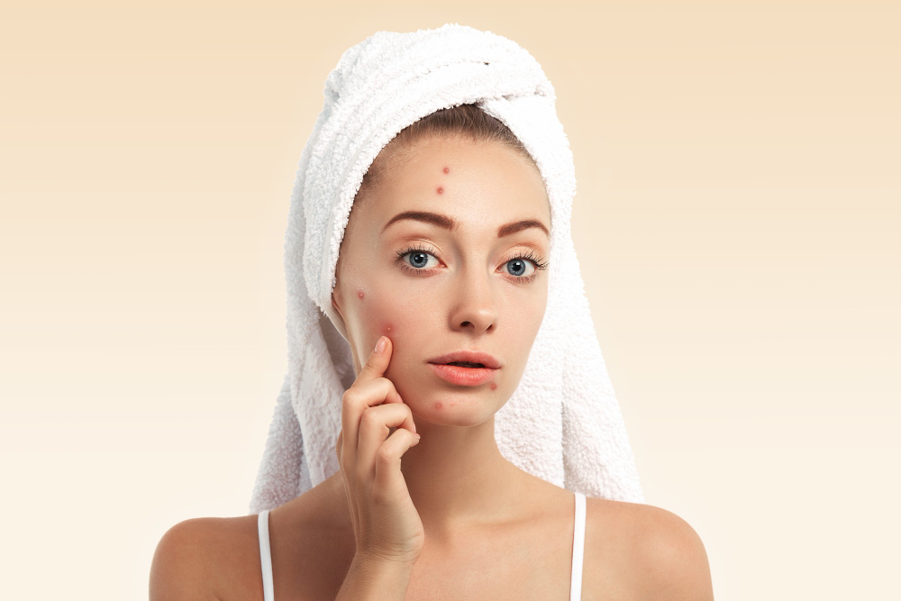 Self Care Tips to Reduce the Risk of Acne Vulgaris (Pimples)