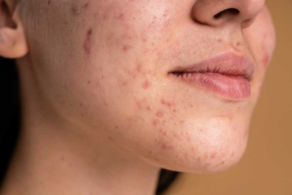 Prevention of Acne Scars: Effective Strategies for Clearer Skin